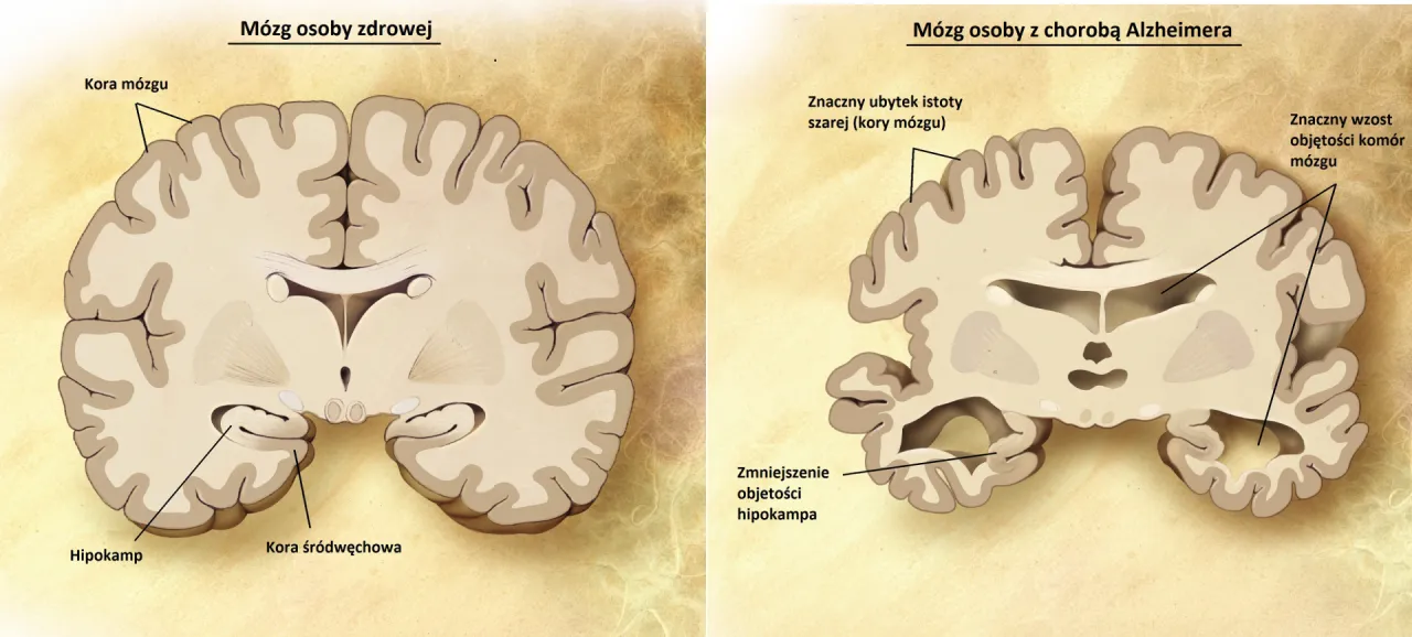 Zdjęcie Choroba Alzheimera: Czy to choroba psychiczna? Wyjaśniamy