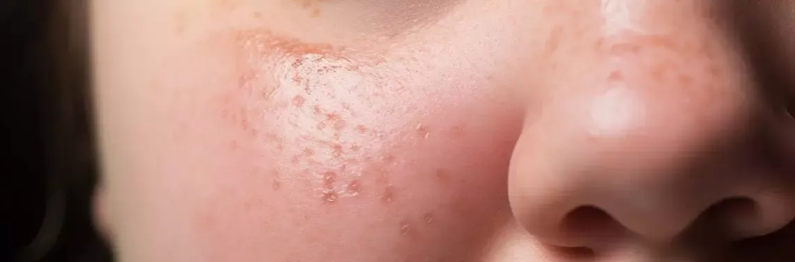 Zdjęcie Drożdżaki u dzieci: 6 objawów i skuteczne metody leczenia