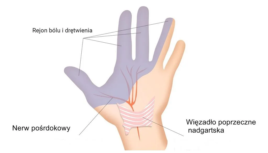Zdjęcie Cieśń nadgarstka: Ile trwa L4 i kiedy bezpieczny powrót?
