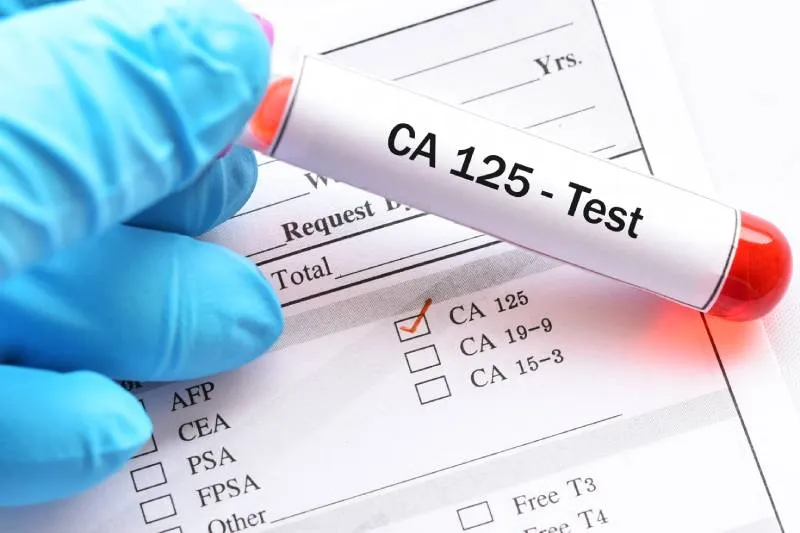 Zdjęcie Badanie CA 125: Co to jest i jak pomaga w diagnostyce raka jajnika?