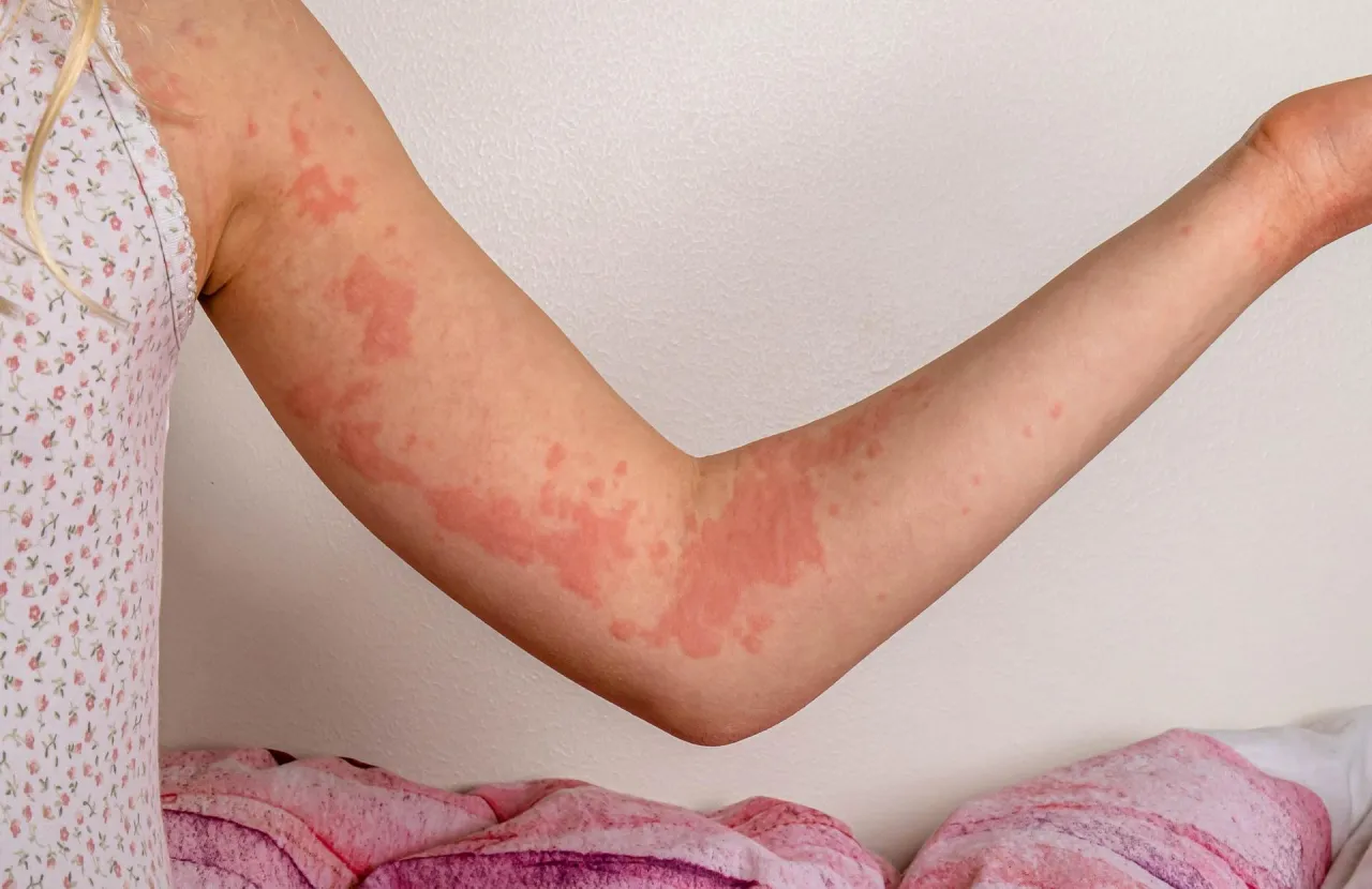 Zdjęcie Alergia skórna objawy: Jak rozpoznać niepokojące symptomy?