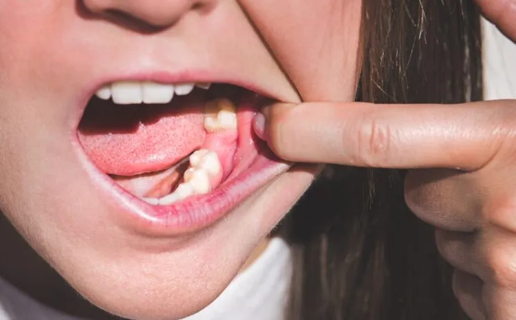 Zdjęcie Jak goi się dziąsło po wyrwaniu zęba? Czego się spodziewać i jak przyspieszyć proces