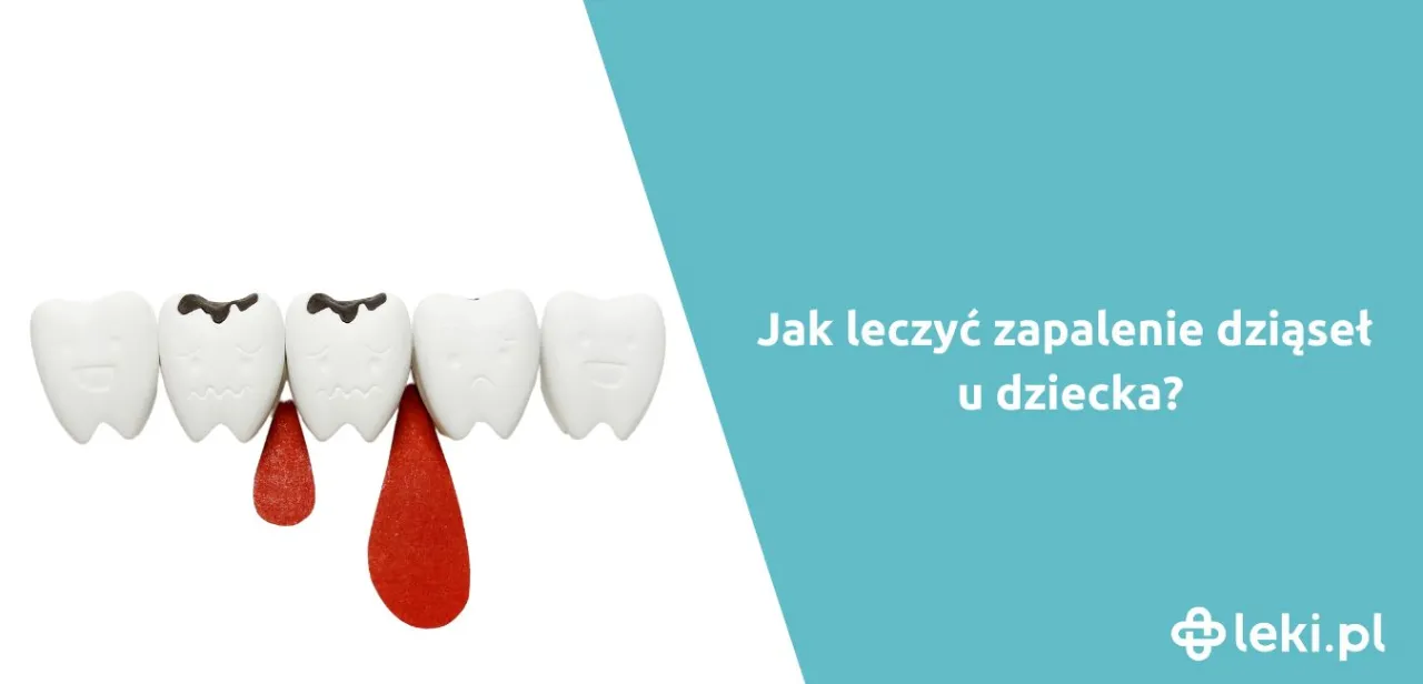 Zdjęcie Skuteczne sposoby na zapalenie dziąseł u dziecka - uniknij bólu