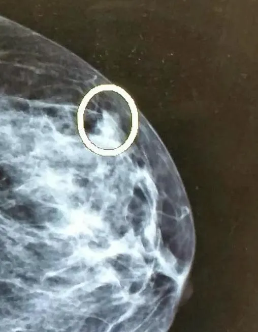 Zdjęcie Powrót do pracy po biopsji piersi: Kiedy i jak bezpiecznie wrócić?