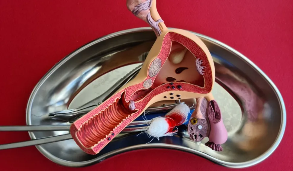 Zdjęcie Kiedy miesiączka po konizacji szyjki macicy? Poznaj ważne informacje