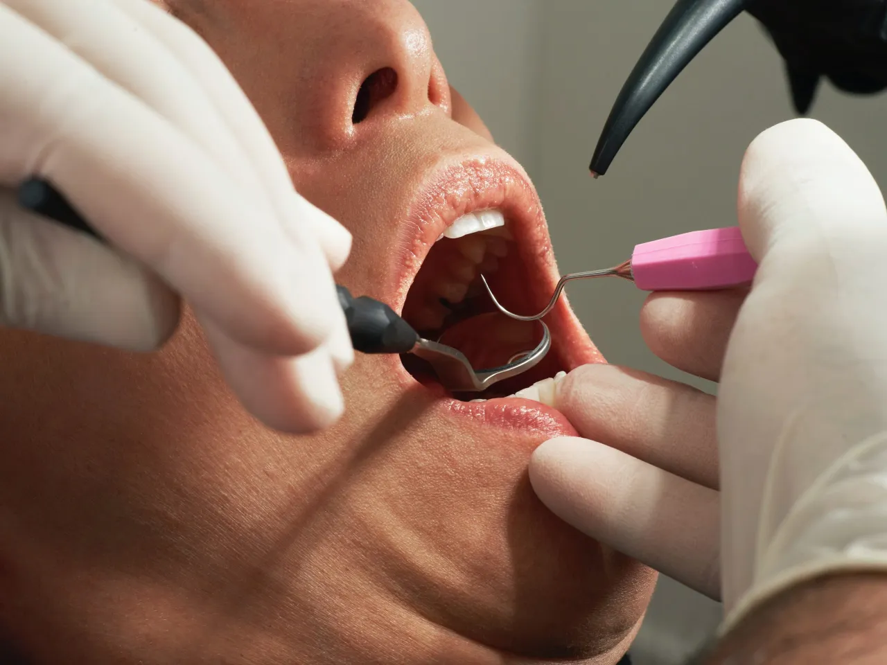 Zdjęcie Jak wygląda wybielanie zębów u dentysty? Odkryj skuteczne metody i efekty