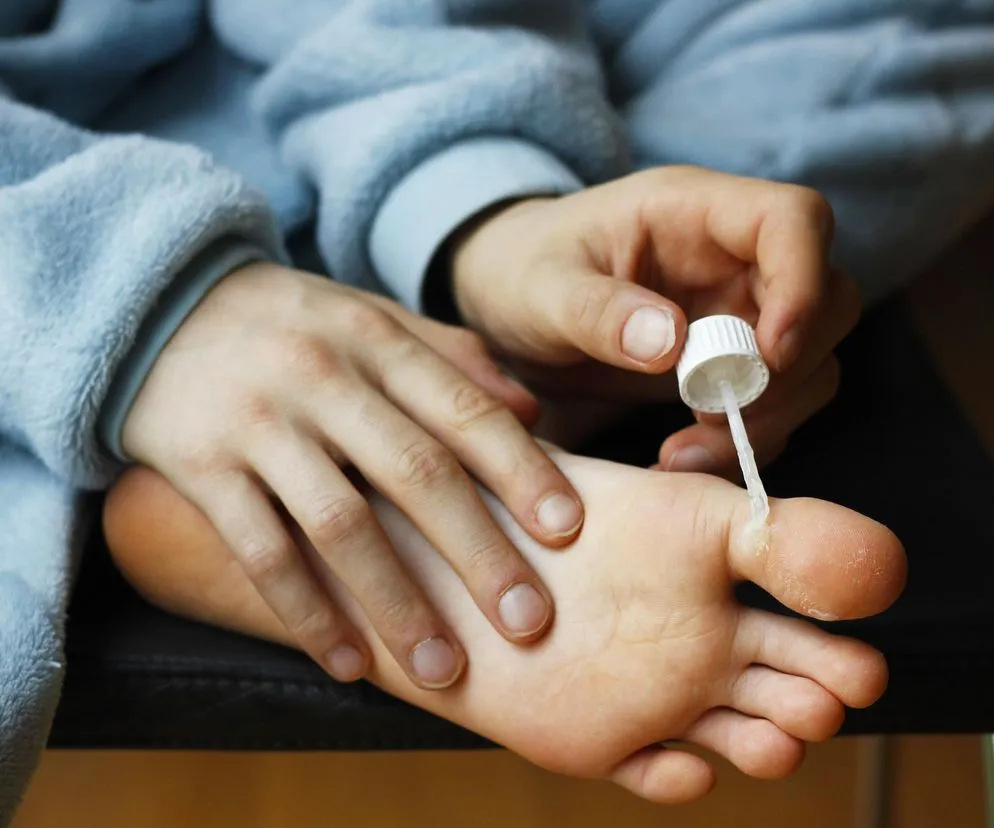 Zdjęcie Skuteczne sposoby na kurzajki dla dziecka - uniknij bólu i problemów