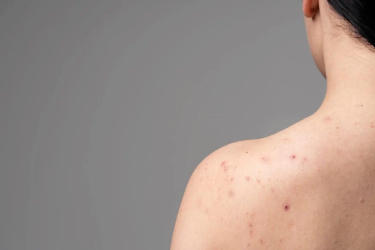 Zdjęcie Skąd się biorą pryszcze? Odkryj przyczyny i sposoby na trądzik