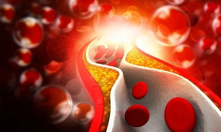 Zdjęcie Jak leczyć cholesterol: Skuteczne metody na obniżenie poziomu cholesterolu
