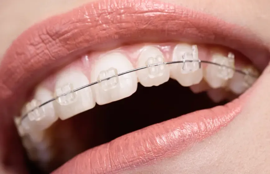 Zdjęcie Przezroczysty aparat na zęby: Jaki jest całkowity koszt leczenia?