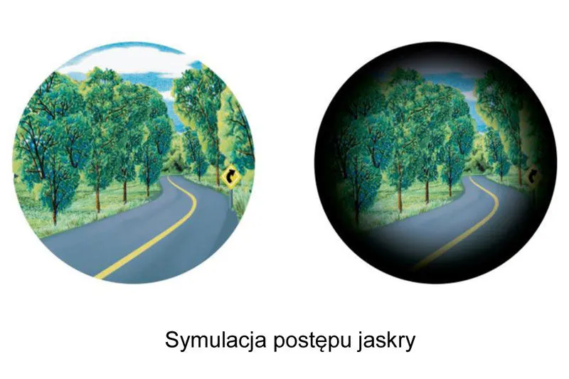 Zdjęcie Jaskra czego nie wolno: unikaj tych nawyków i produktów, by chronić wzrok