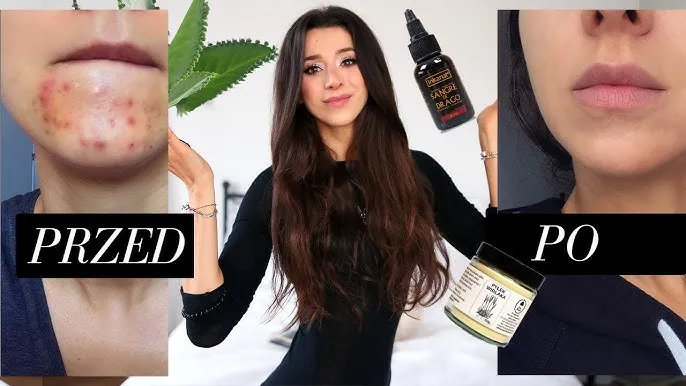 Zdjęcie Jak usunąć pryszcze z twarzy – skuteczne metody na szybkie rezultaty