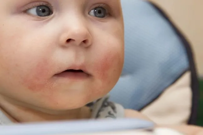 Zdjęcie Jak rozpoznać objawy alergii na gluten u dzieci i co robić?
