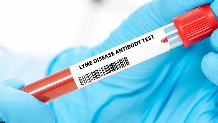 Zdjęcie Jak odczytać wyniki badań na boreliozę i uniknąć fałszywych diagnoz