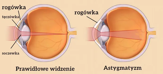 Zdjęcie Astygmatyzm czy to poważne? Sprawdź, co oznacza dla twojego wzroku