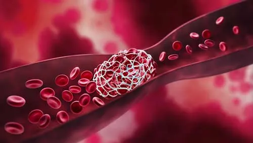 Zdjęcie Zatorowość płucna: 5 kluczowych badań diagnostycznych