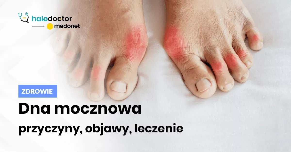 Zdjęcie Podwyższony poziom kwasu moczowego: przyczyny, objawy i skuteczne leczenie