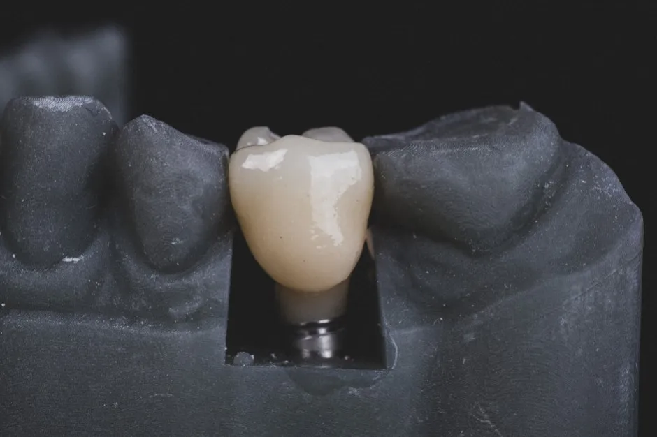 Zdjęcie Leki na osteoporozę, które nie powodują martwicy kości szczęki – bezpieczne opcje