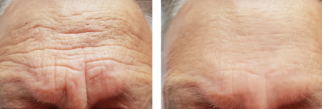 Zdjęcie Lwia zmarszczka: botoks czy kwas hialuronowy – co naprawdę działa?