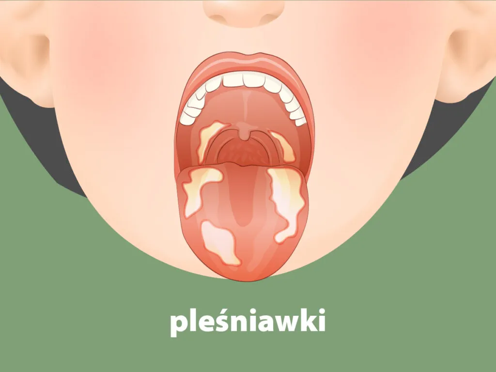 Zdjęcie Jak długo trwa zapalenie jamy ustnej u dziecka? Czas trwania objawów