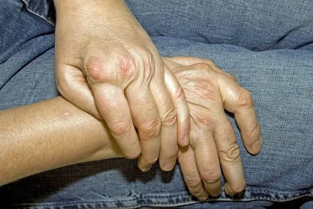 Zdjęcie RZS - choroba autoimmunologiczna: objawy i opcje leczenia.