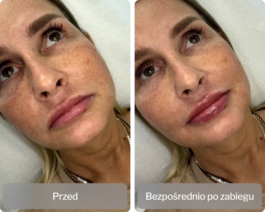 Zdjęcie Po jakim czasie widać efekty kwasu hialuronowego? Oczekiwania i rzeczywistość