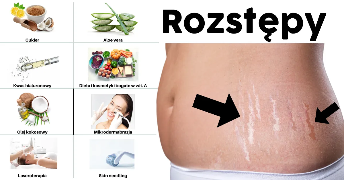 Zdjęcie Jak skutecznie zlikwidować rozstępy po ciąży: 8 sprawdzonych metod