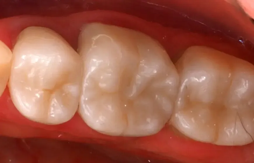 Zdjęcie Czy można jeść po dentyście? Sprawdź, kiedy to bezpieczne dla zdrowia