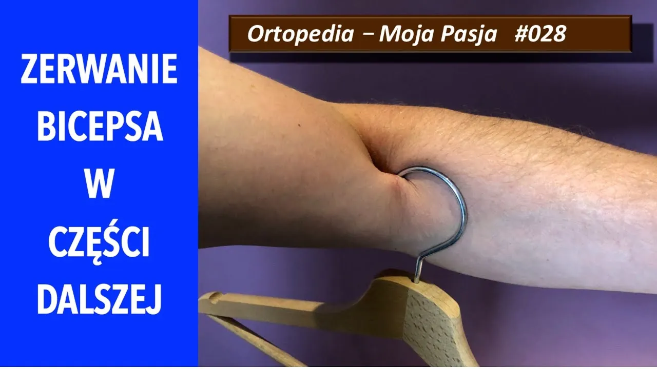 Zdjęcie Naderwany biceps: 5 kluczowych objawów, które musisz znać