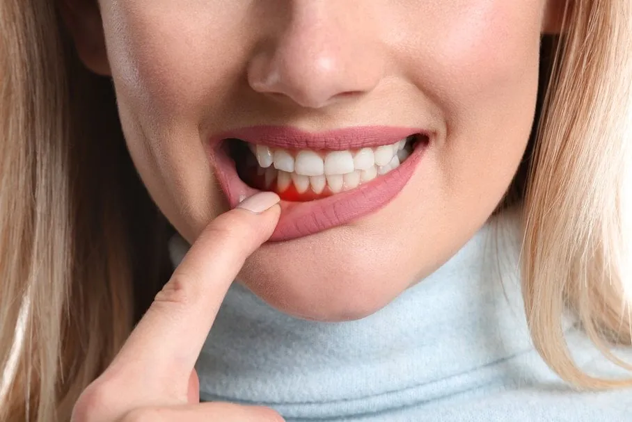 Zdjęcie Co na bolące dziąsło od ósemki – skuteczne sposoby na ulgę i kiedy iść do dentysty