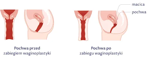 Zdjęcie Jak długo L4 po plastyce pochwy? Poznaj czas rekonwalescencji