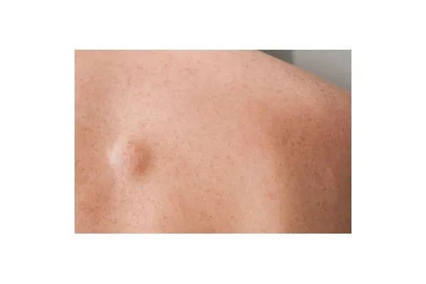 Zdjęcie Tłuszczak do jakiego lekarza? Sprawdź, jak uzyskać pomoc medyczną