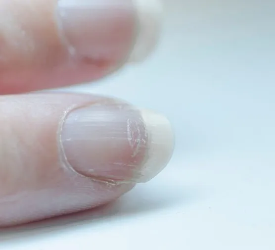 Zdjęcie Podłużne prążki na paznokciach - przyczyny i co mogą oznaczać