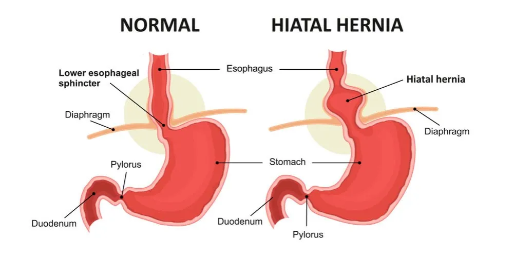 Zdjęcie Hernia de hiato: Identifica sus síntomas y cuándo buscar ayuda.