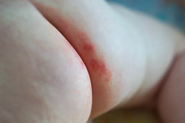 Zdjęcie Jak wyglądają odparzenia u niemowlaka i jak im zapobiegać?