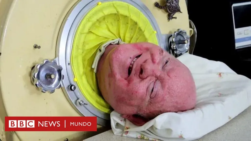 Zdjęcie Cómo funciona el pulmón de acero y su impacto en la respiración