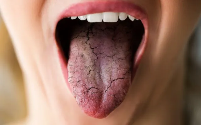 Zdjęcie Skuteczne metody na suchość jamy ustnej – poznaj najlepsze rozwiązania