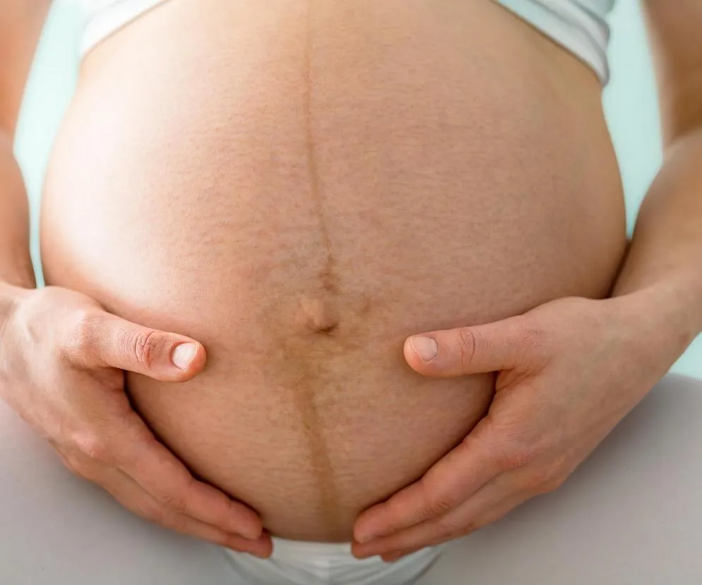 Zdjęcie Kiedy zniknie linia na brzuchu po porodzie? Fakty i porady dla mam