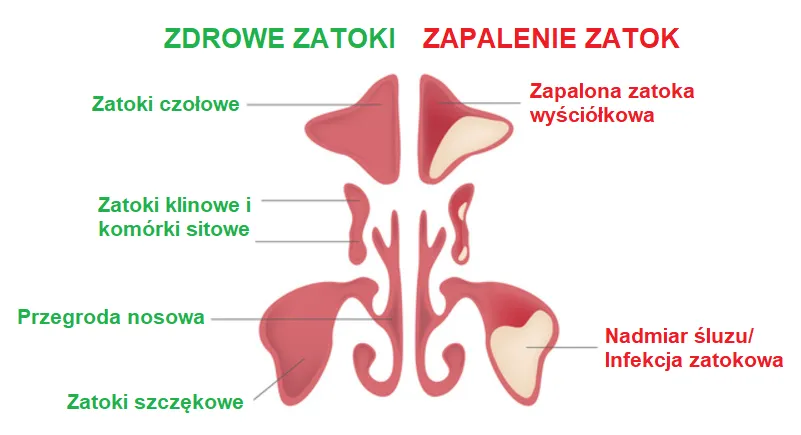 Zdjęcie Katar z krwią przy zapaleniu zatok: przyczyny i objawy