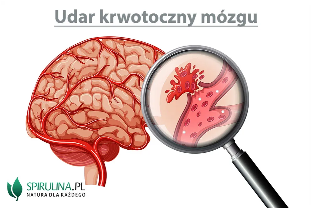 Zdjęcie Udar krwotoczny objawy – jak rozpoznać zagrożenie i szybko reagować