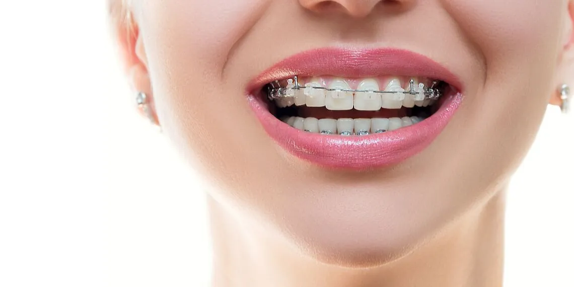 Zdjęcie Jak wygląda zakładanie aparatu na zęby – co musisz wiedzieć przed wizytą