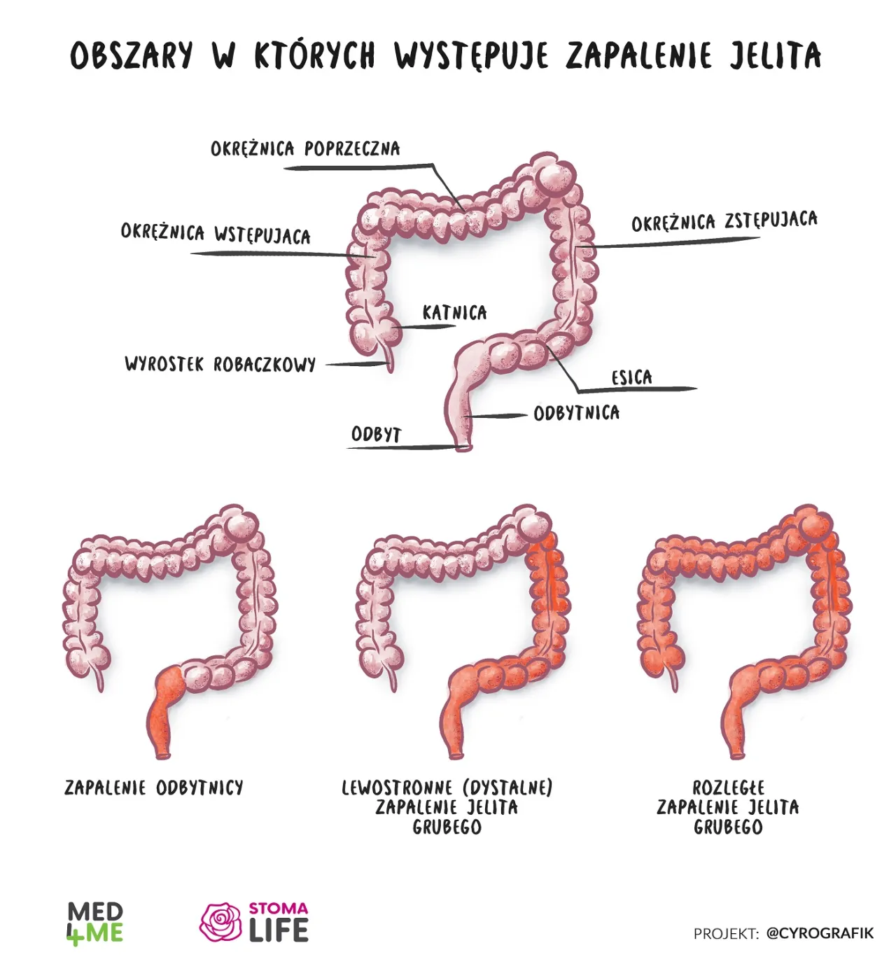 Zdjęcie Zapalenie jelita grubego objawy - poznaj niebezpieczne sygnały zdrowotne