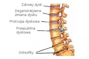 Zdjęcie Zaburzenia korzeni rdzeniowych i splotów nerwowych – objawy, przyczyny i leczenie