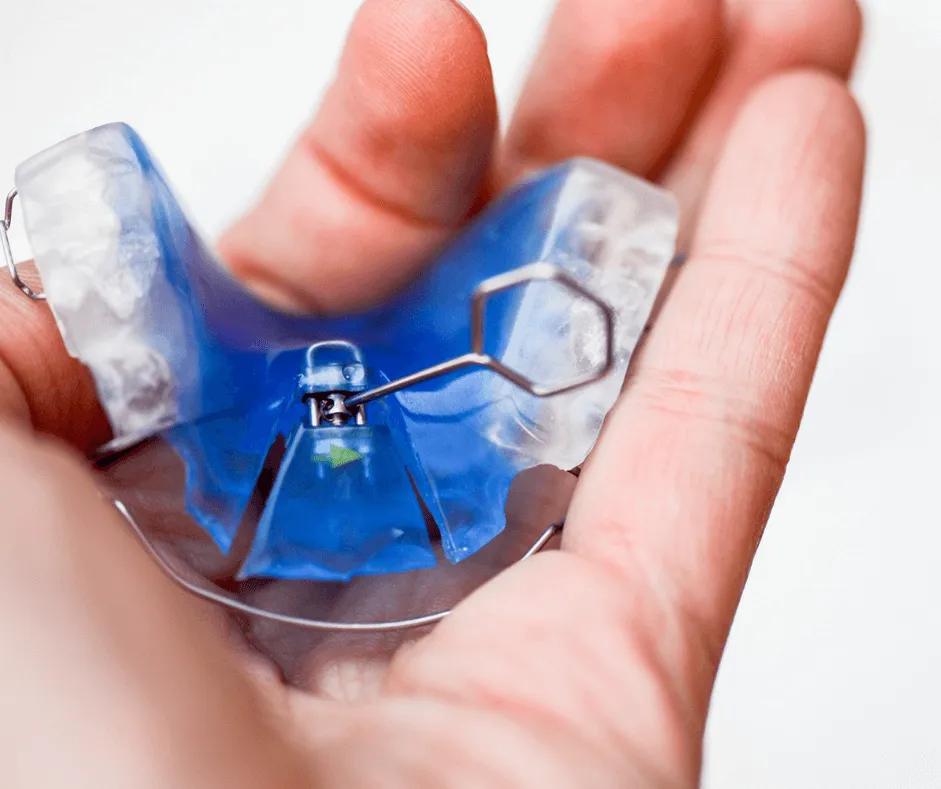 Zdjęcie Jak wygląda aparat ruchomy na zęby dla dzieci – cechy i korzyści