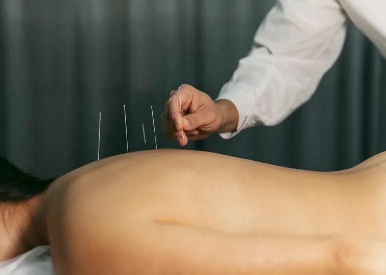 Zdjęcie Akupunktura kręgosłupa: Ryzyko, skutki uboczne i bezpieczeństwo zabiegu