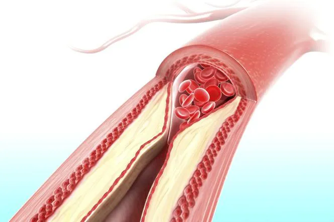 Zdjęcie Jakie są normy cholesterolu i jak uniknąć zdrowotnych zagrożeń