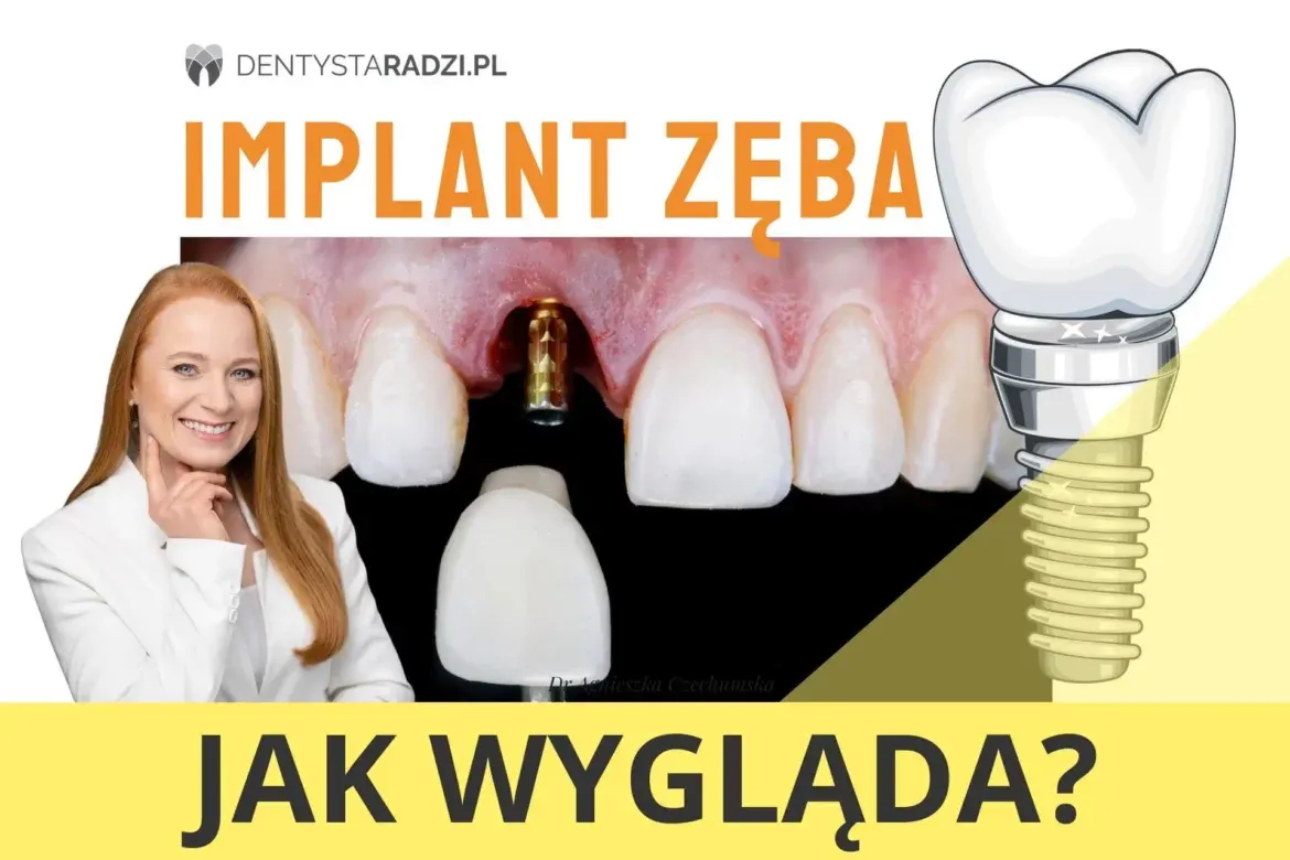 Zdjęcie Jak wygląda implant zęba? Wszystko o budowie i procesie wszczepiania