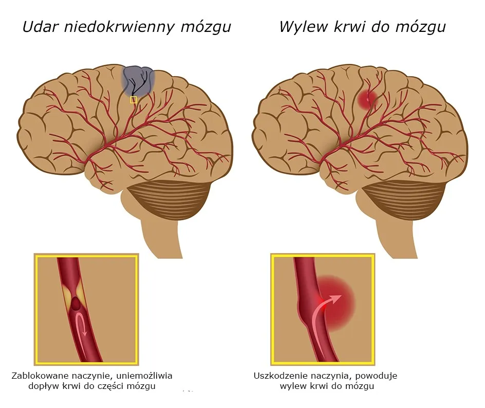Zdjęcie Udar czy wylew – poznaj kluczowe różnice, objawy i jak im zapobiec