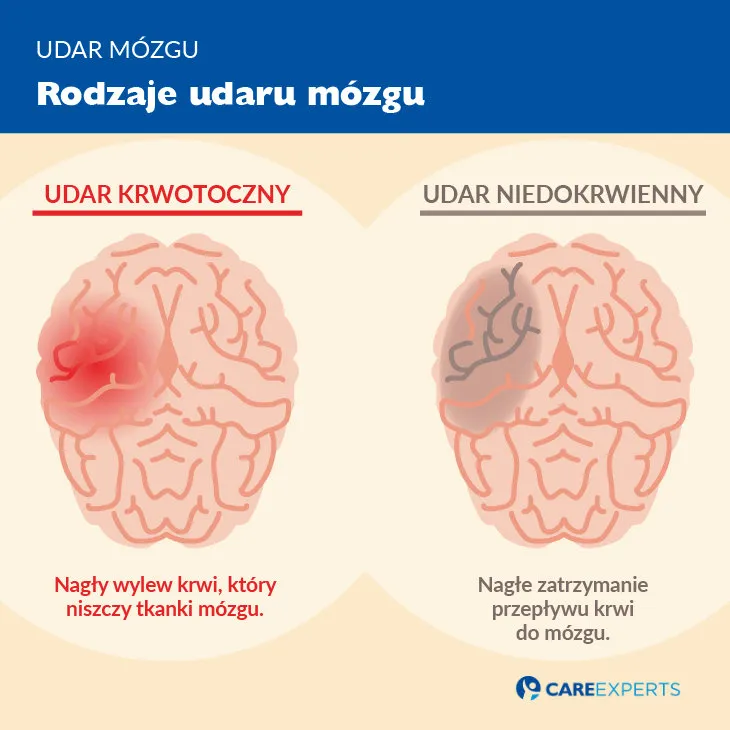 Zdjęcie Jak rozpoznać udar niedokrwienny: 7 kluczowych objawów do zapamiętania