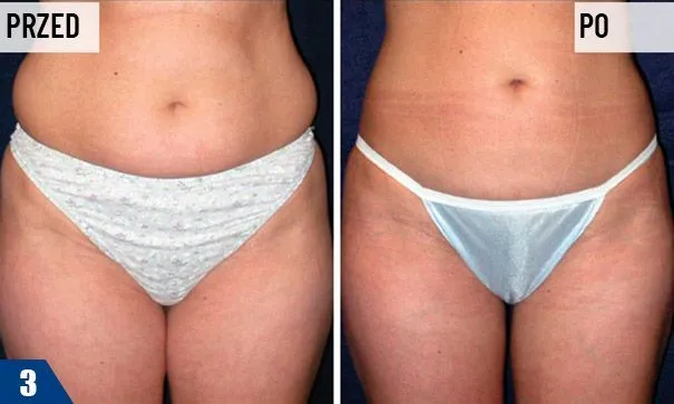 Zdjęcie Czy liposukcja laserowa jest skuteczna? Efekty i ryzyko zabiegu